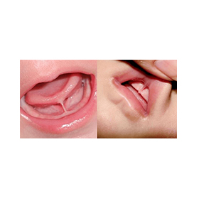 tongue lip ties